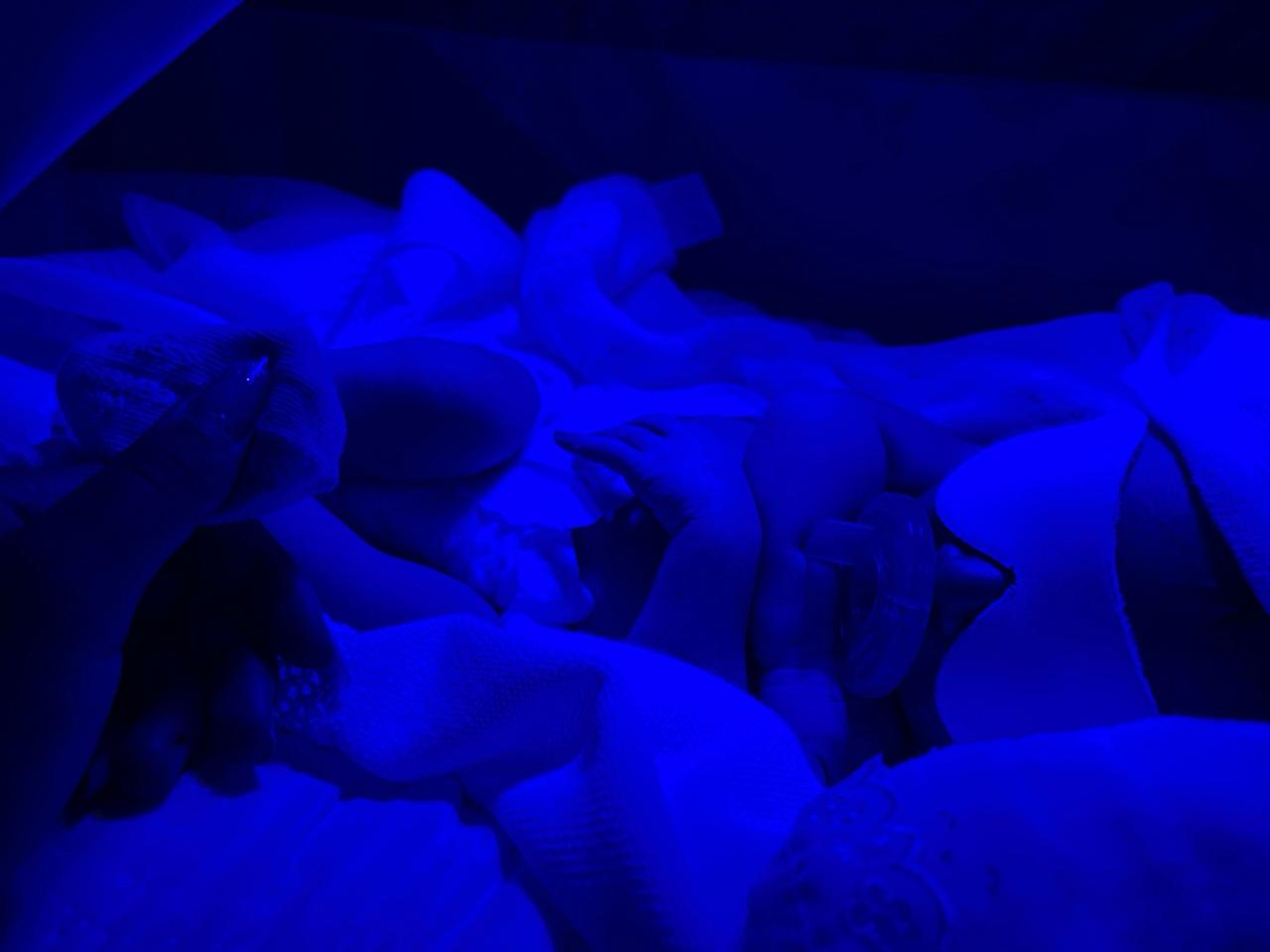 Detalhe do bebê sob luz azul de fototerapia